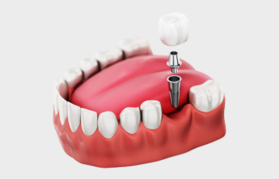 Single Dental Implant
