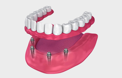 All-on-4 Dental Implants