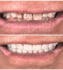 orthosquare teeth whitening Before & After Gallery