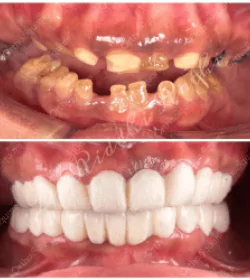 orthosquare teeth whitening Before & After Gallery