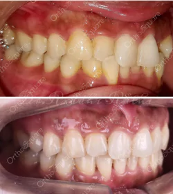 orthosquare aligner Before & After Gallery