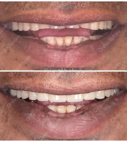 orthosquare smile design Before & After Gallery