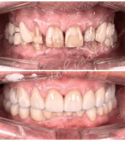 orthosquare teeth whitening Before & After Gallery