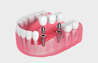 Multiple Dental Implants