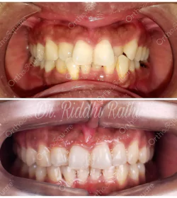 orthosquare aligner Before & After Gallery