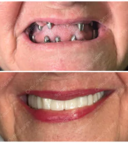 orthosquare implant Before & After Gallery