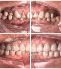 orthosquare teeth whitening Before & After Gallery