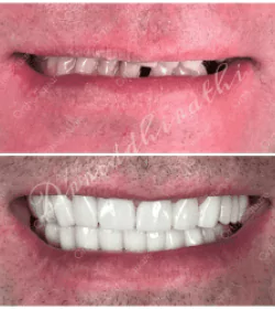 orthosquare teeth whitening Before & After Gallery
