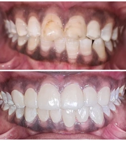 orthosquare teeth whitening Before & After Gallery