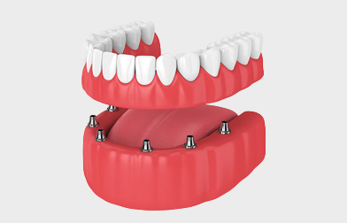 All-on-6 Dental Implants