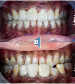 orthosquare smile design Before & After Gallery
