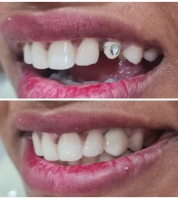 orthosquare bridges Before & After Gallery